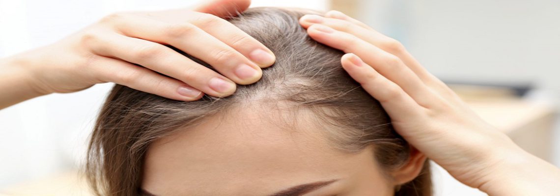 همه چیز درباره ریزش موی هورمونی + 7 درمان مهم