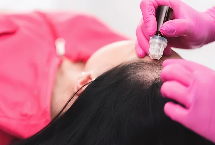 میکرونیدلینگ مو : همه چیز درباره میکرونیدلینگ مو + عوارض و مراحل درمان