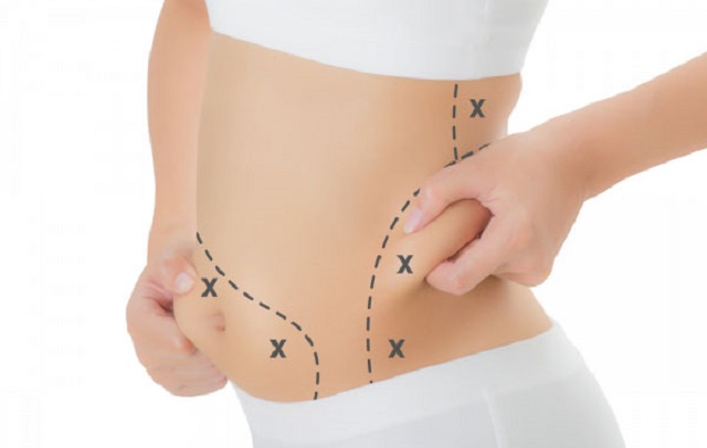 Abdominal cosmetic surgery