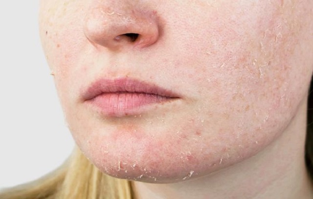 عوامل تاثیرگذار در خشکی پوست صورت