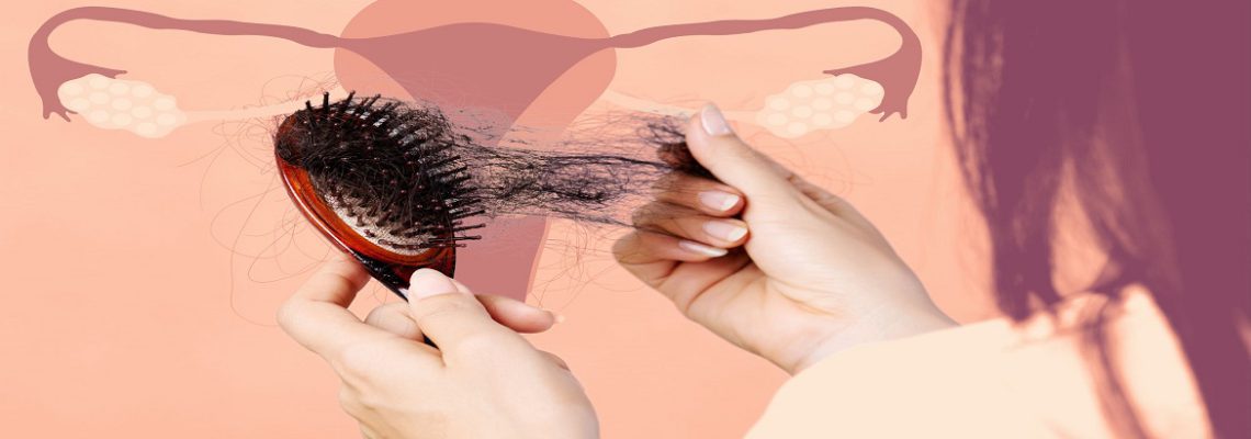 روش های درمان ریزش مو به دلیل تنبلی تخمدان چیست؟