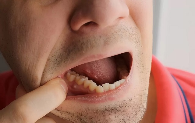 پیشگیری از آبسه دندان