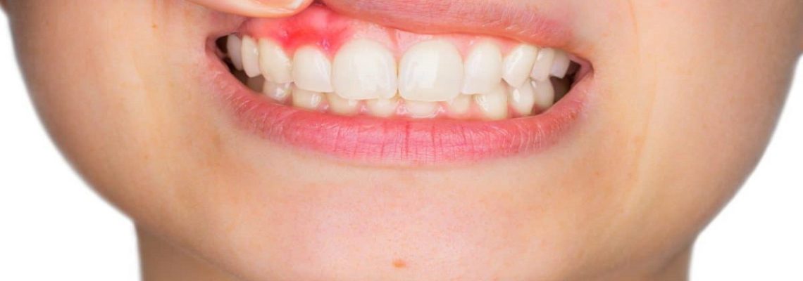 آبسه دندان چیست ؟ علل، علائم و راه های درمان