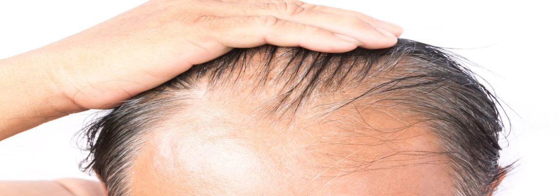 پیشگیری و درمان ریزش مو از جلوی سر