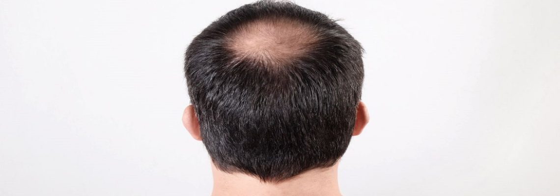 راهکارهای درمان ریزش موی شدید چیست؟