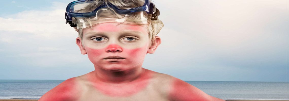راه های درمان پوست صورت آفتاب سوخته چیست؟