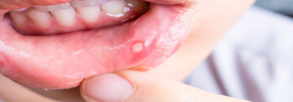 آفت دهان چیست و راه های درمان آن
