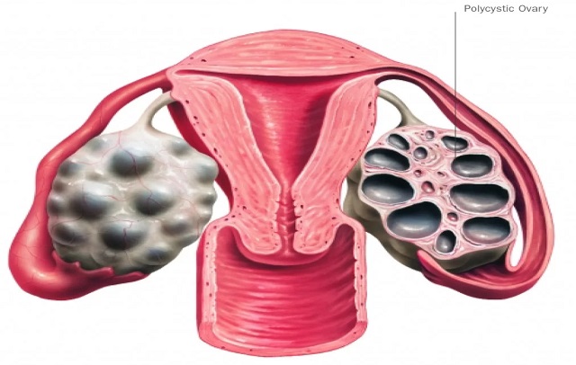 تشخیص سندروم تخمدان پلی کیستیک