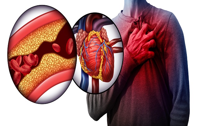 دلایل آنژین صدری یا درد قفسه سینه