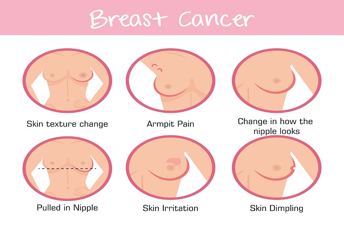  سرطان پستان، علائم، تشخیص، و درمان