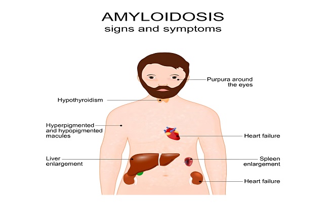   آمیلوئیدوز: از مبانی تا درمان