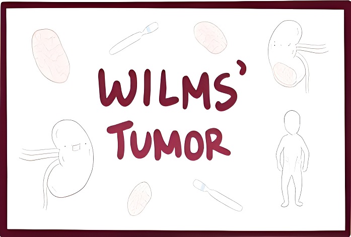  بیماری تومور ویلمز : آگاهی، درمان و امید