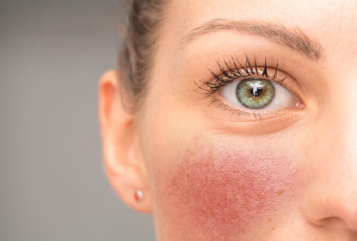 بیماری پوستی روزاسه چیست؟