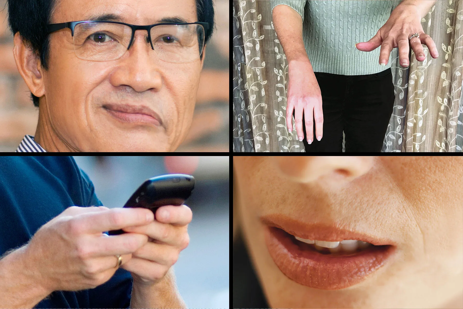 عوارض و پیامدهای سکته مغزی