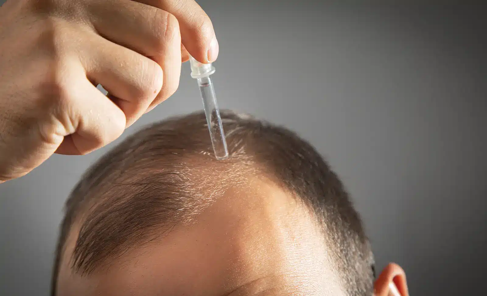 درمان ریزش مو