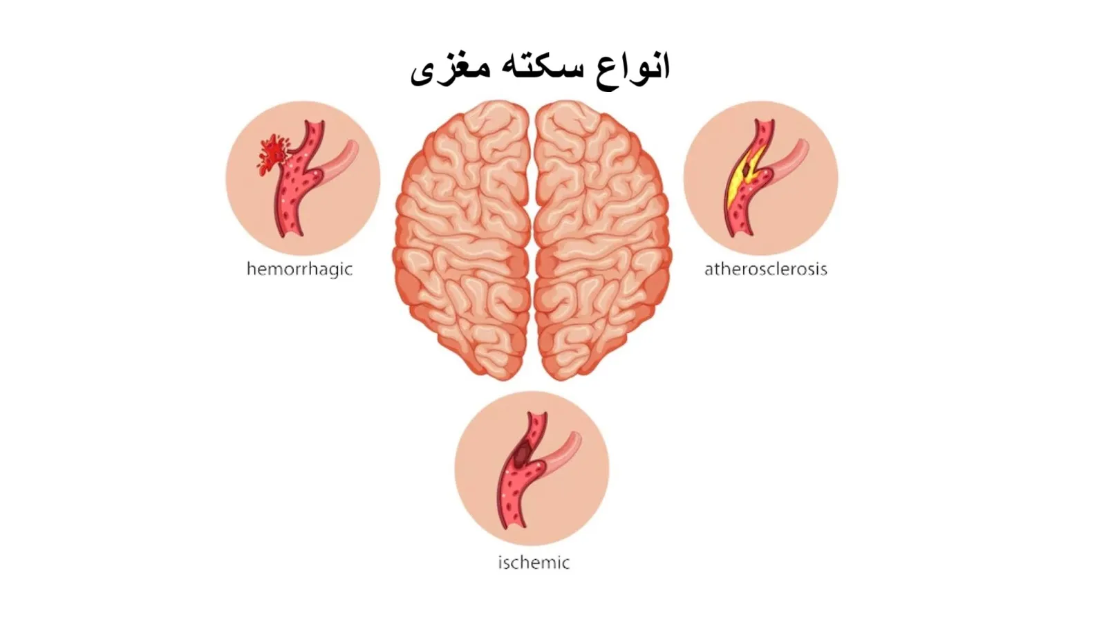 انواع سکته مغزی